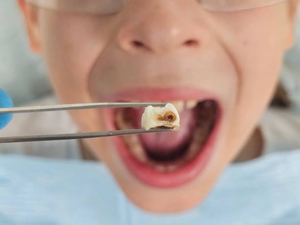 Best Emergency Root Canal Therapy in Hazleton, PA
